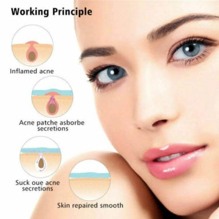 Acne Patch Kit For Pimples, Invisible Hydrocolloid Patches, 24 Count - diagram showing patches absorbing acne secretions and skin repair on face