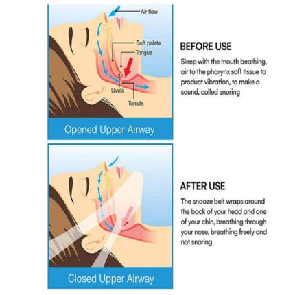 Blue Triangular Chin Strap Snoring Aid For Comfortable Sleep - before and after diagram showing opened vs closed upper airway with strap reducing mouth breathing
