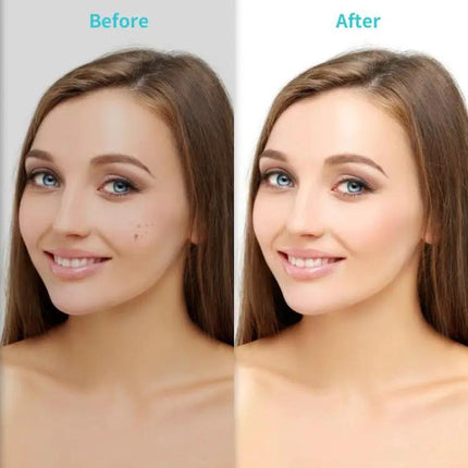 Xpreen Dark Spot Remover For Freckles Everyday Use | Syndmart