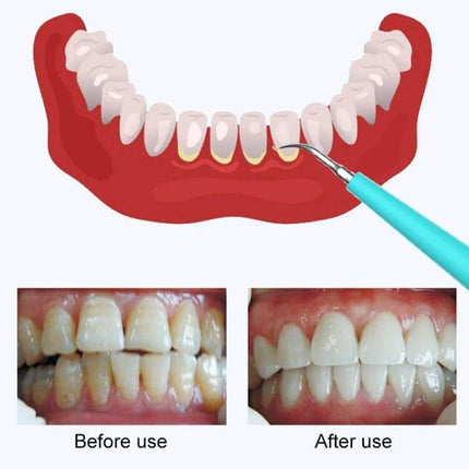 LSHOW Teeth Polisher With Five Speed USB Charging For Home Use removing tea and coffee stains with ultrasonic scaler before and after results
