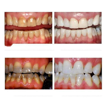 Nano Teeth Whitening Set Enamel Safe For Daily Care before and after photos showing brighter front teeth after 1–2 minute touch-ups