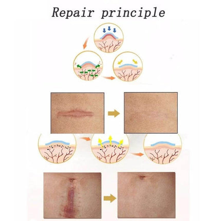 Organic Silicone Gel Scar Patch 3.5 x 12 cm For Scar Care showing repair principle and before and after scar improvement