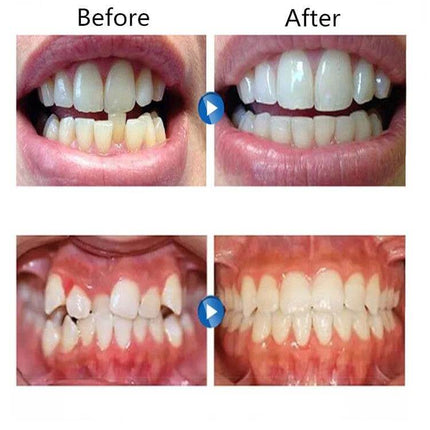 Orthodontic Silicone Simulation Braces For Nighttime Use showing before and after teeth alignment results, nighttime silicone mouth appliance demonstration
