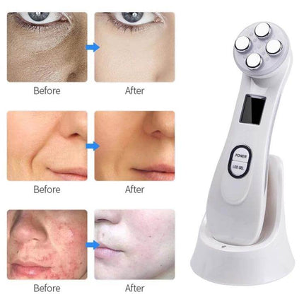 Radio Frequency Facial Beauty Pen For Wrinkle Reduction showing device with before and after skin tightening and wrinkle reduction results