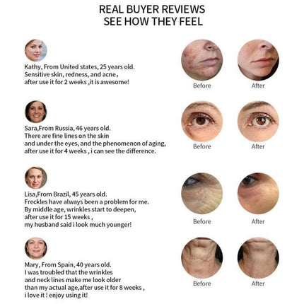 Radio Frequency Facial Beauty Pen For Wrinkle Reduction before and after customer reviews showing improved skin texture and reduced fine lines