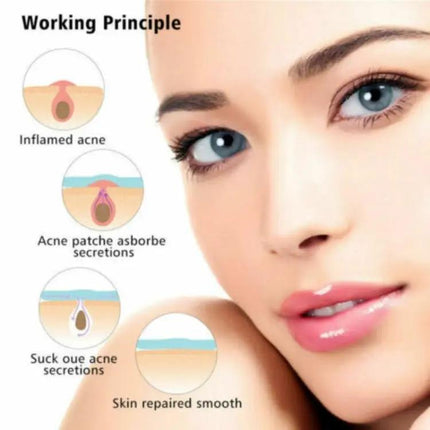 Acne Patch Kit For Pimples, Invisible Hydrocolloid Patches, 24 Count | Syndmart