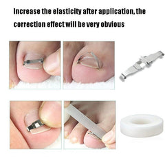 Ingrown Toenail Correction System with Orthopedic Buckle and PE Tape