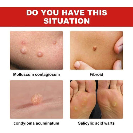 Ximonth 20ml Mole And Wart Remover Liquid For Skin showing close-up images of molluscum, fibroid, condyloma and plantar warts