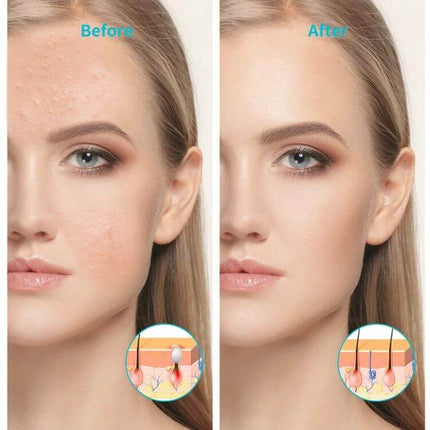 XPREEN Acne Light Therapy Device, Wireless for Home Use showing before and after facial results with 36 LED blue and red beads for acne care