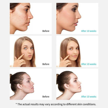 Xpreen Pore Cleanser For Home Facial With LED Screen showing before and after 10 weeks acne and pore improvement results