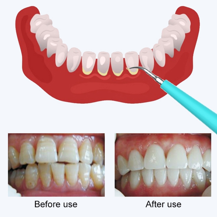 LSHOW YJK015A Waterproof Electric Teeth Polisher - USB Charging, High-frequency Vibration 6 Illustration Showing Dental Cleaning Process With Before And After Images Of Teeth.